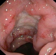 Abb. 2  Klinisches Bild eines schweren Lymphogranuloma venereum. In der hochauflösenden Anoskopie bestehen putride, tiefreichende  Ulzerationen des gesamten Rektums.