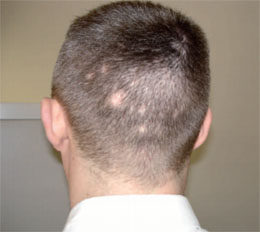 Abb. 4  Alopecia syphilitica